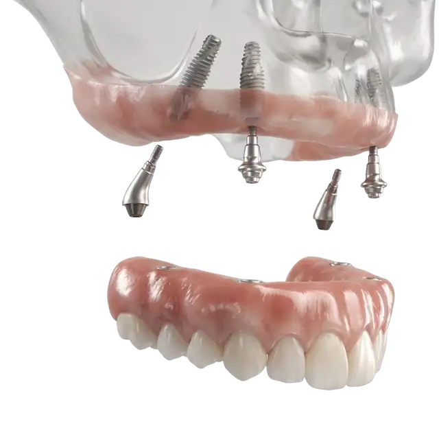 3D diagram of full-arch dental implants: titanium posts placed in the upper jaw, abutment connectors, and an implant-supported arch of new teeth