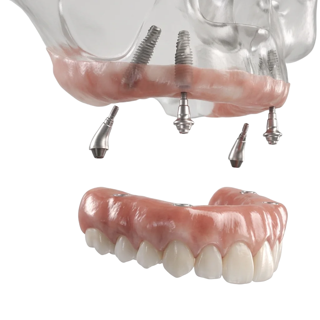 3D diagram of full-arch dental implants: titanium posts placed in the upper jaw, abutment connectors, and an implant-supported arch of new teeth